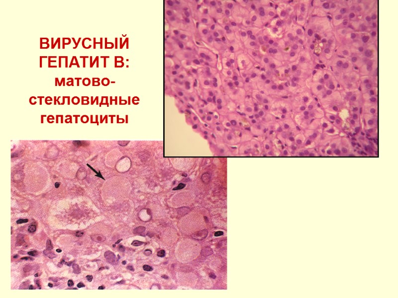 ВИРУСНЫЙ ГЕПАТИТ В: матово-стекловидные гепатоциты